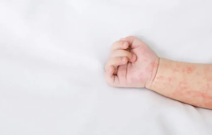 Czy dziecko że strupami po ospie może iść do przedszkola bez obaw?