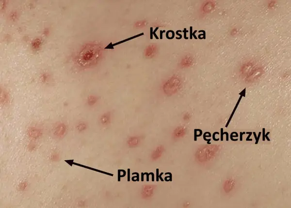 Ospa wietrzna u dziecka - Jak wygląda wysypka krok po kroku?